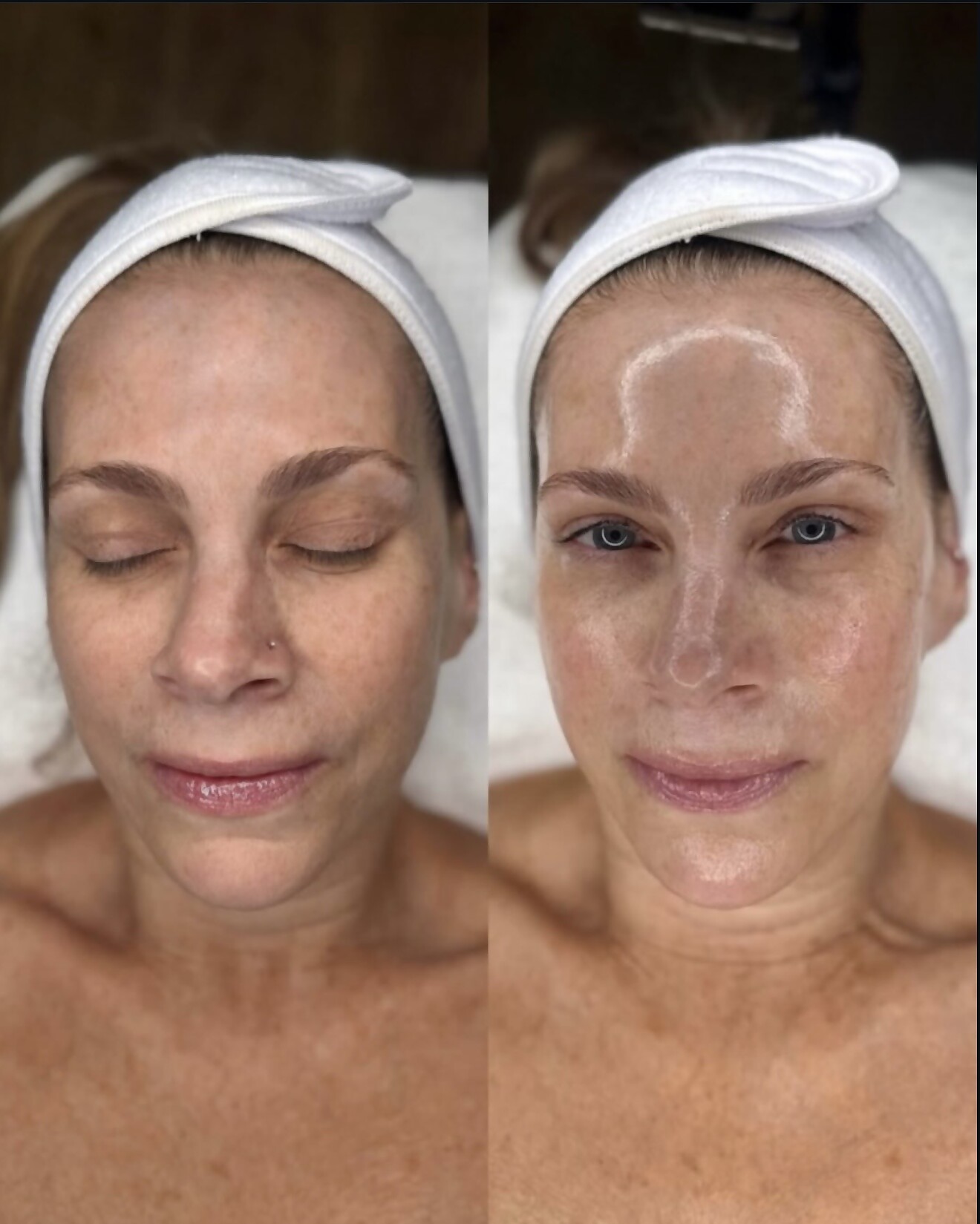 Before and after of a Hydrafacial facial treatment — SHAY Esthétique clinic
