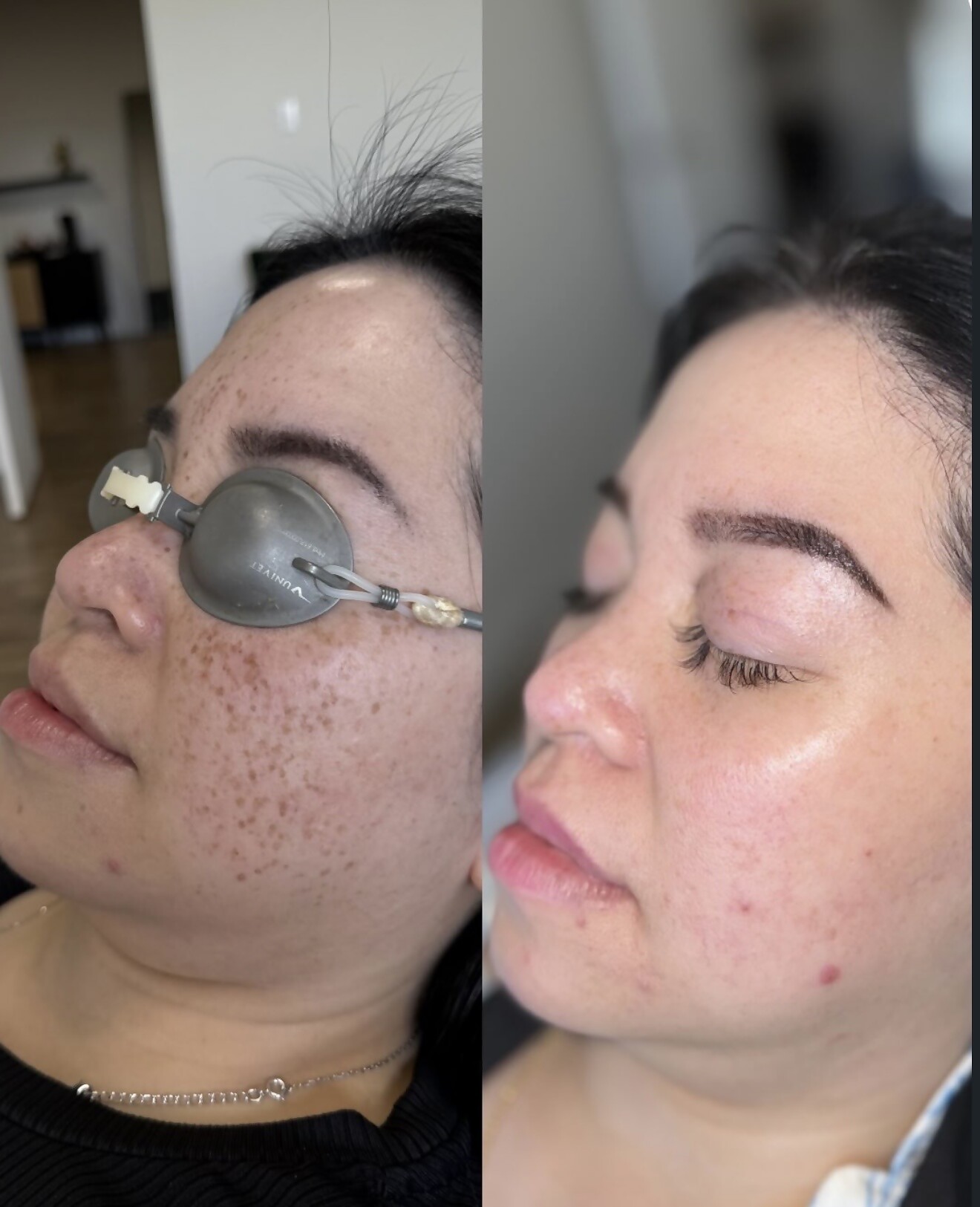 Before and after of a facial pigmentation treatment — SHAY Esthétique clinic