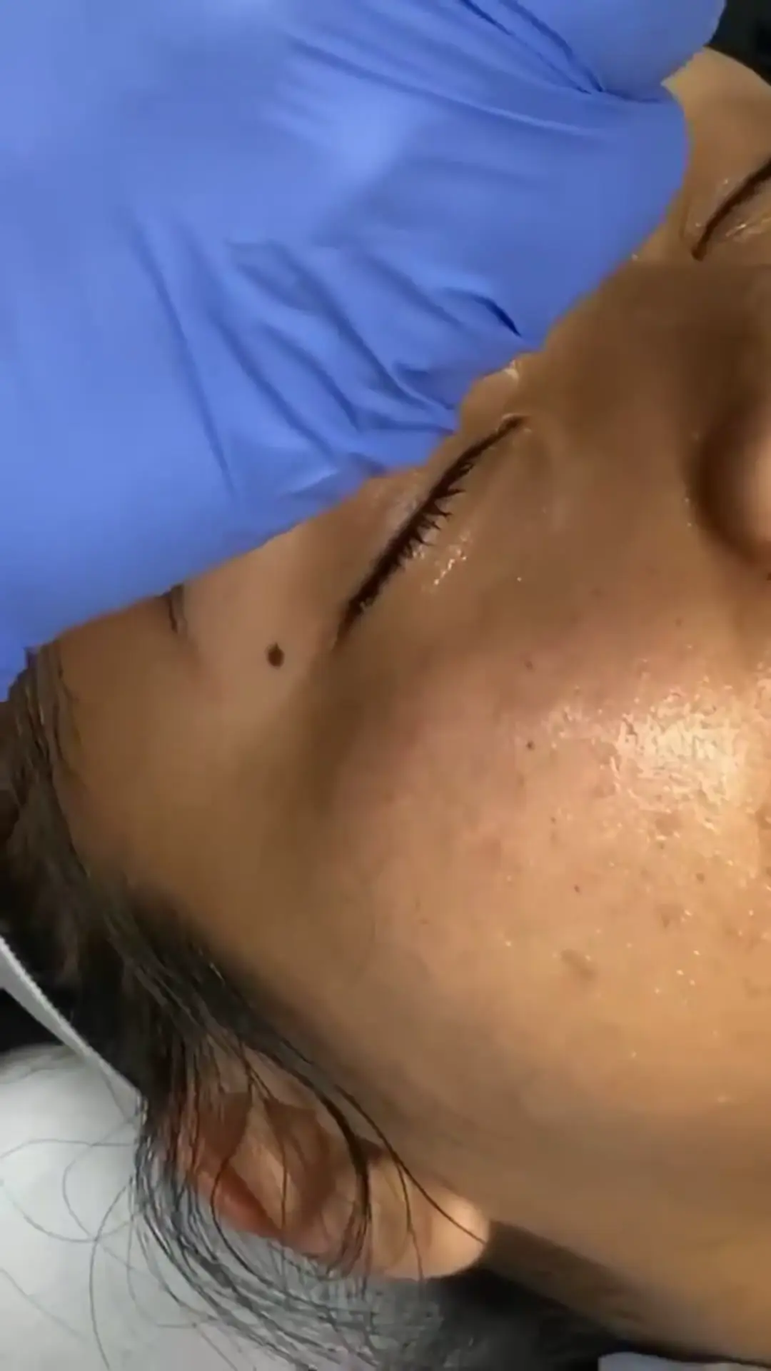Facial microneedling in progress: skin smoothed with serum, the aesthetician's gloved hand — SHAY Esthétique, Ahuntsic Montreal