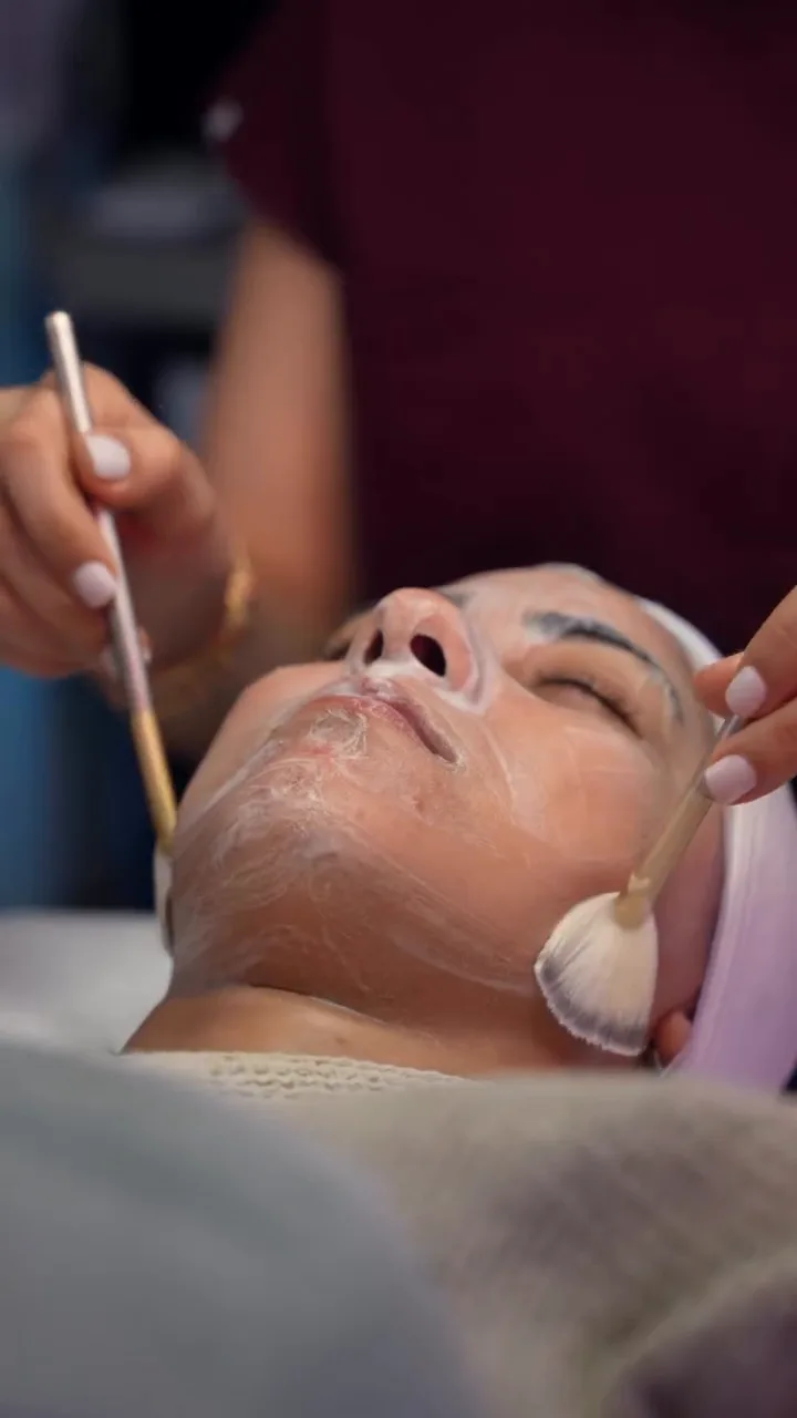 Peeling chimique au TCA — SHAY Esthétique, Ahuntsic Montréal
