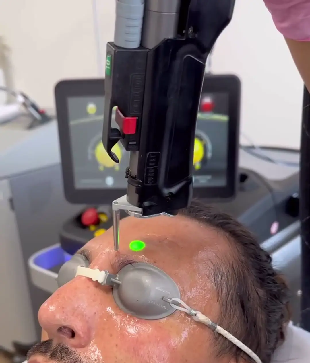 Cynosure Elite iQ laser photorejuvenation: the handpiece and its green aiming spot on the forehead, protective eye shields in place — SHAY Esthétique, Ahuntsic Montreal