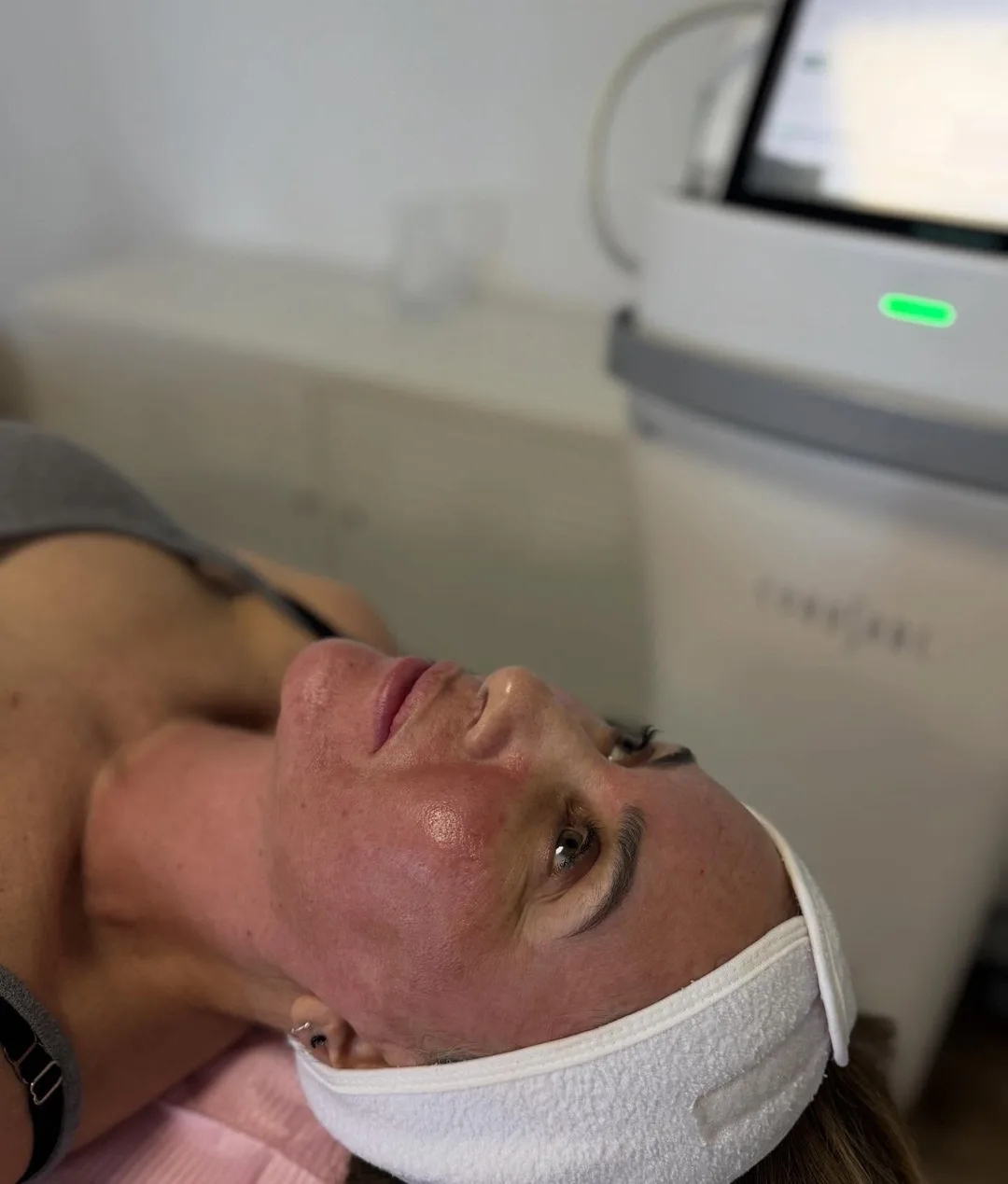 Microneedling RF Potenza™ — SHAY Esthétique, Ahuntsic Montréal