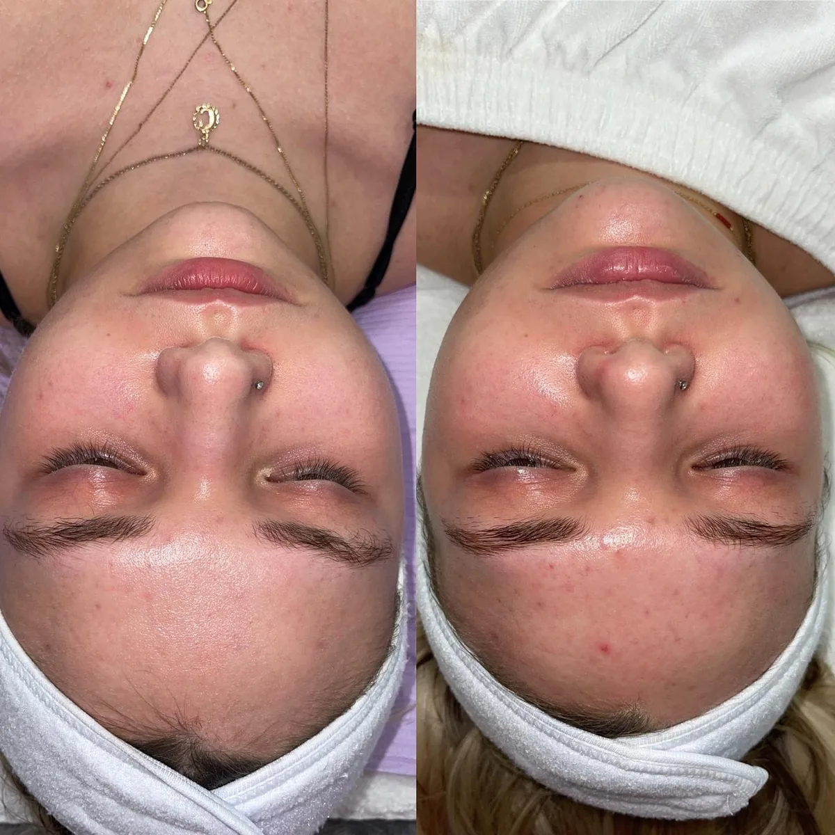 Before and after: face — Microneedling