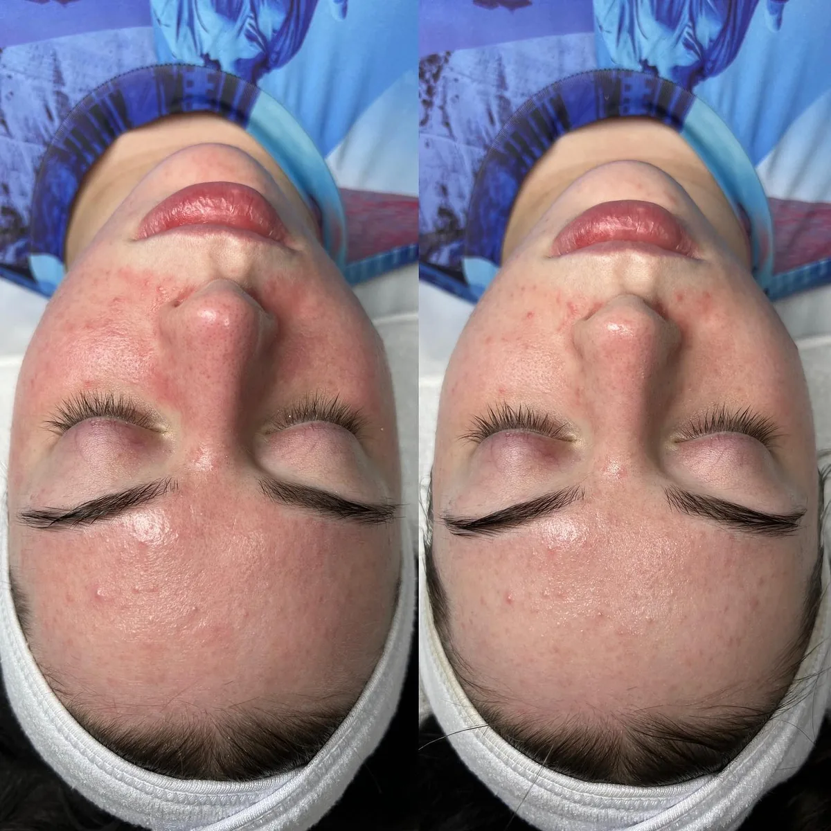 Before and after: face — Rosacea facial — before and immediately after