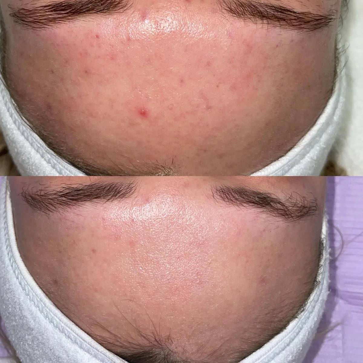 Before and after: forehead — Microneedling