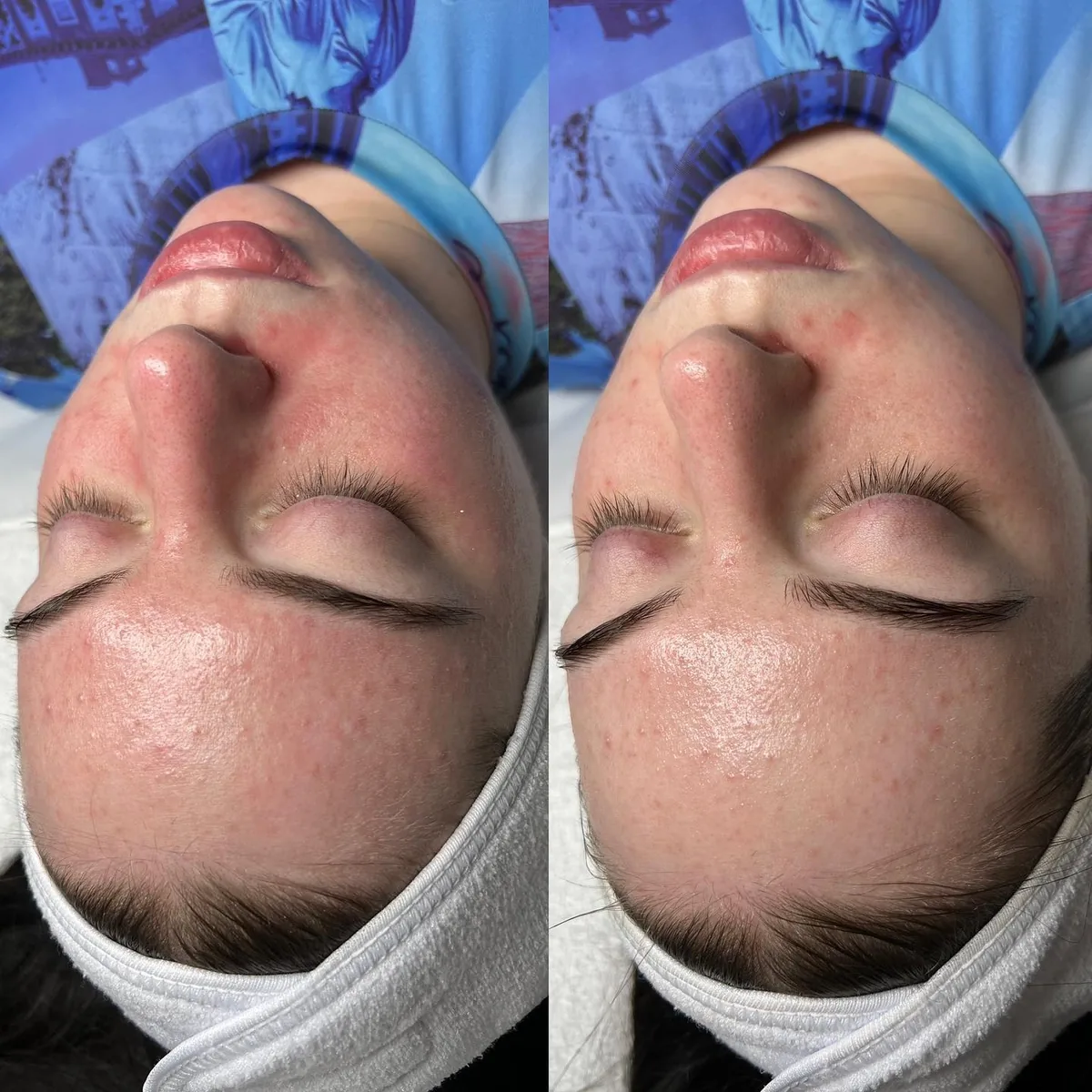 Before and after: face, side view — Rosacea facial — before and immediately after