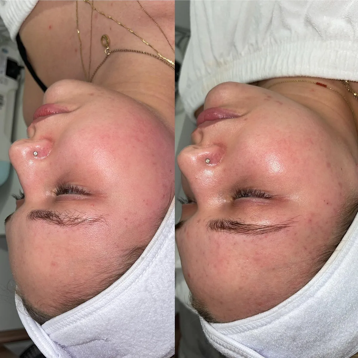 Before and after: cheek — Microneedling