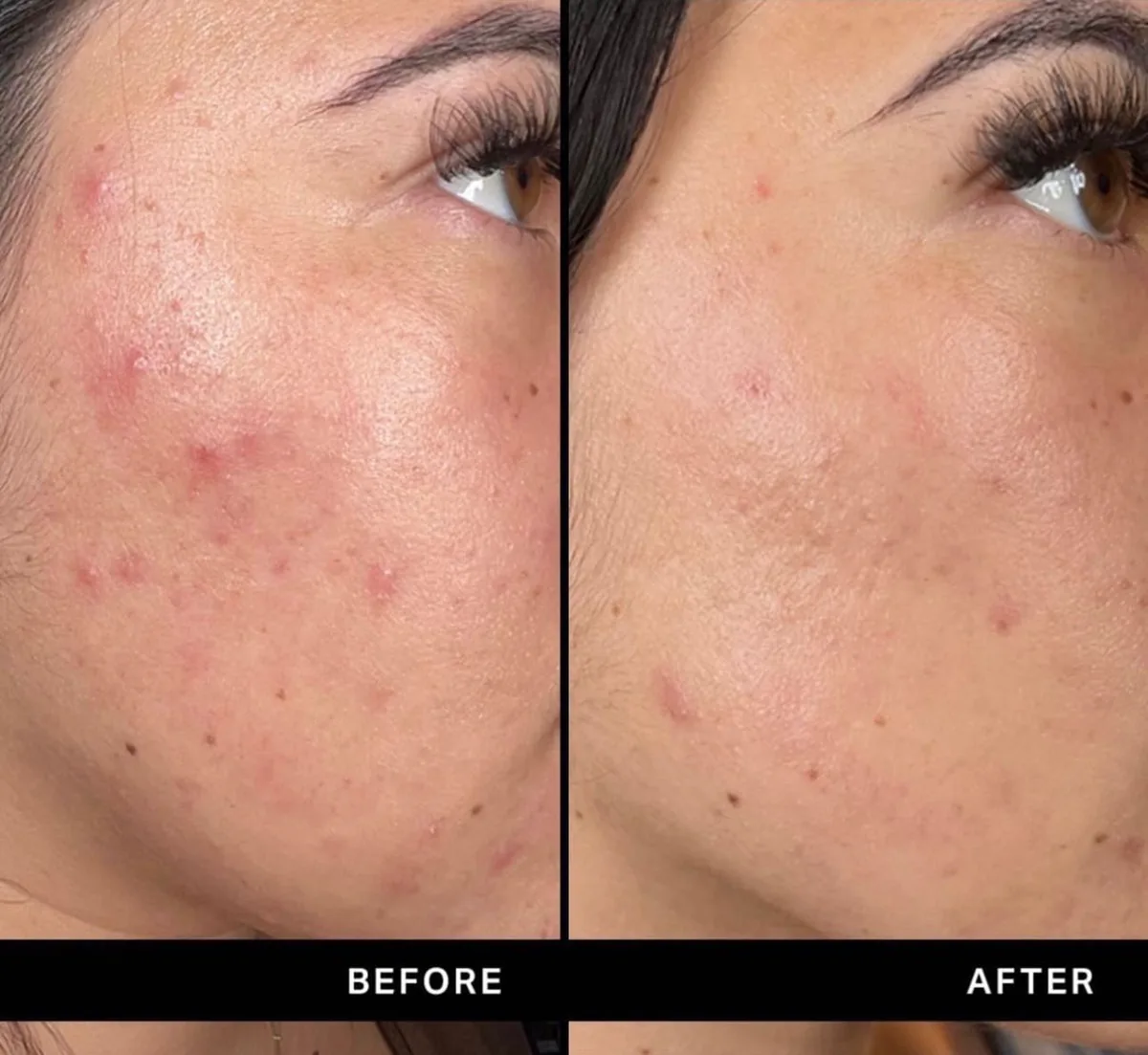 Before and after: cheek — Hydrafacial