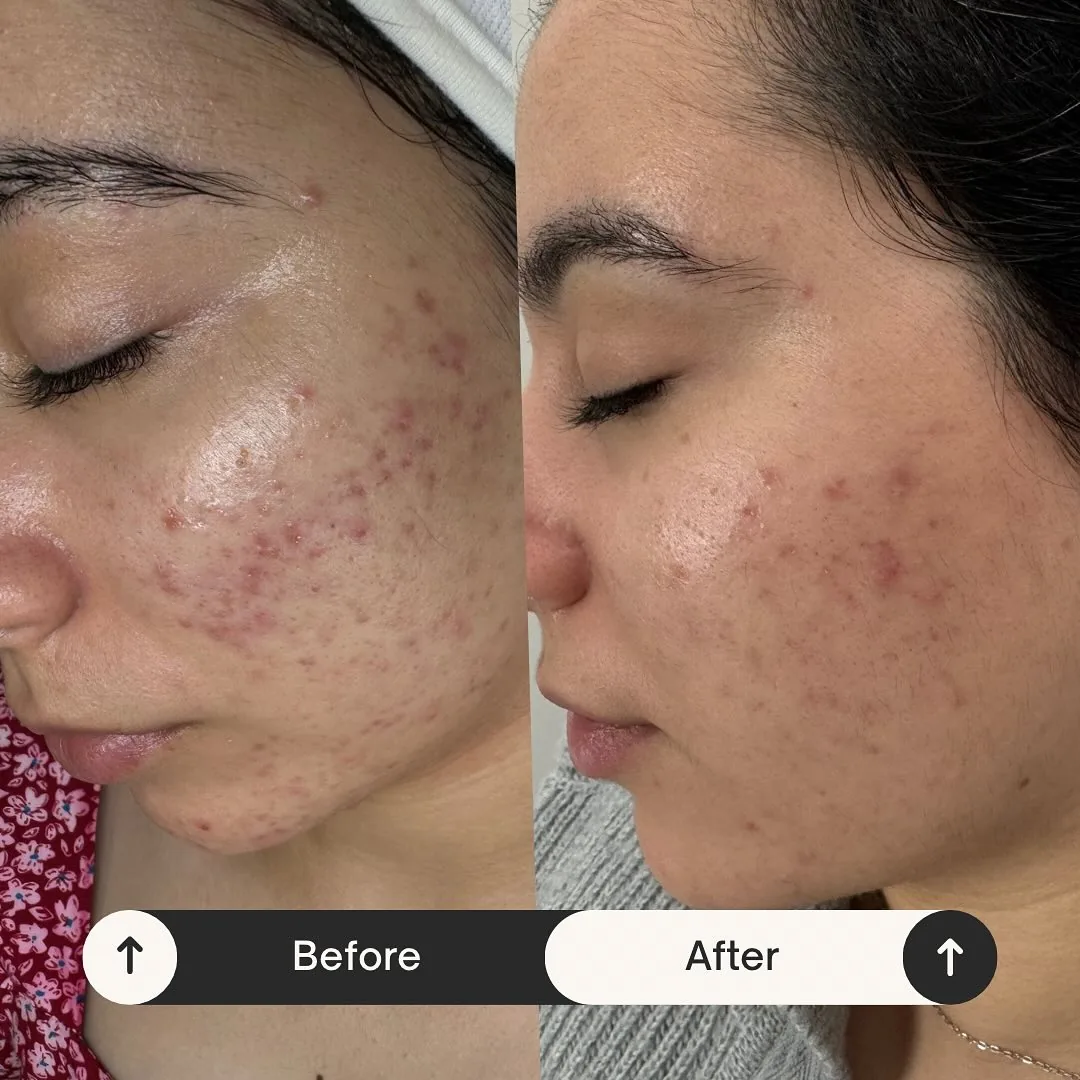 Before and after: cheek — Course of chemical peels (3 to 6 sessions), a regular skincare routine