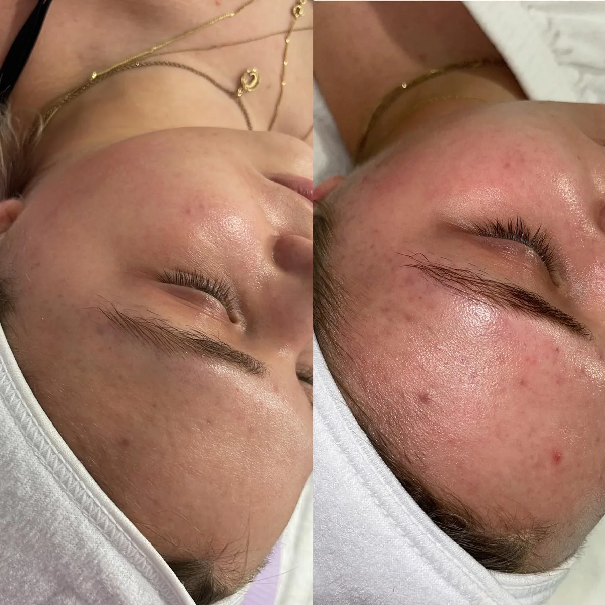Before and after: temple — Microneedling