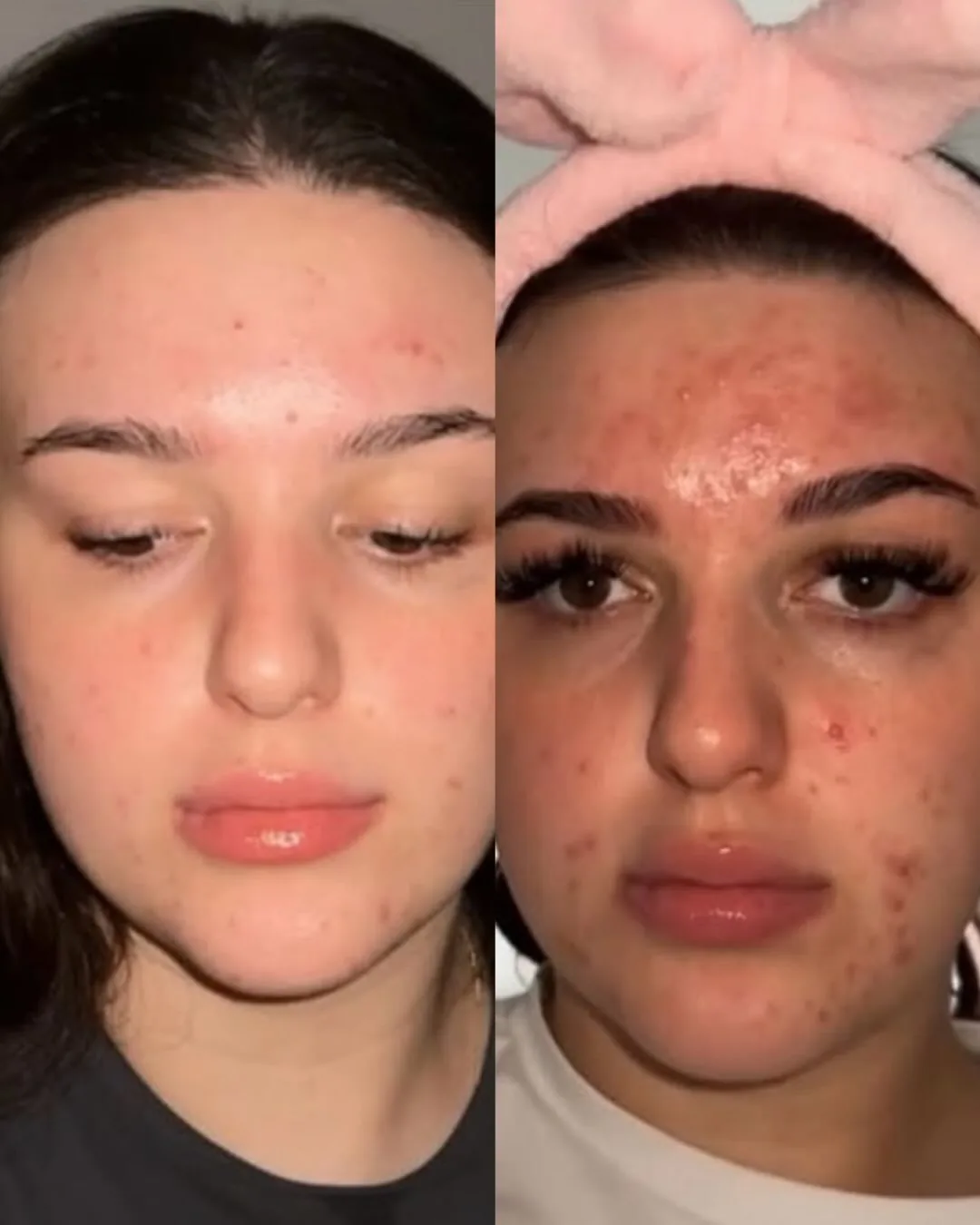 Before and after: face — Chemical peel + Hydrafacial