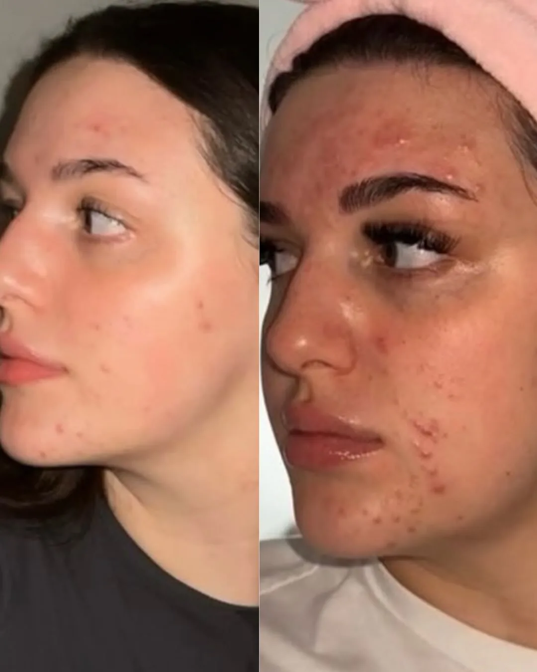 Before and after: face, side view — Chemical peel + Hydrafacial