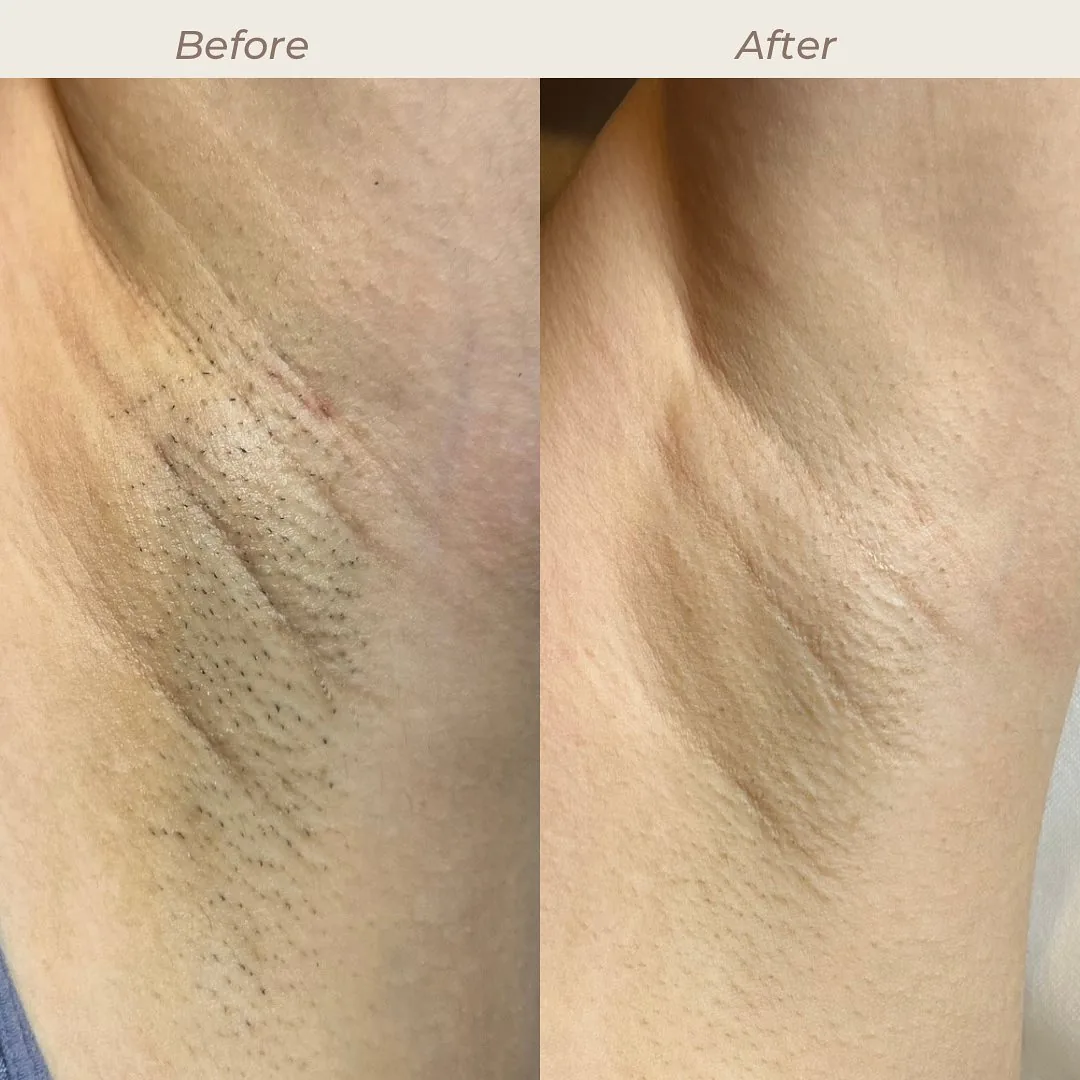 Before and after: underarms — 3 sessions