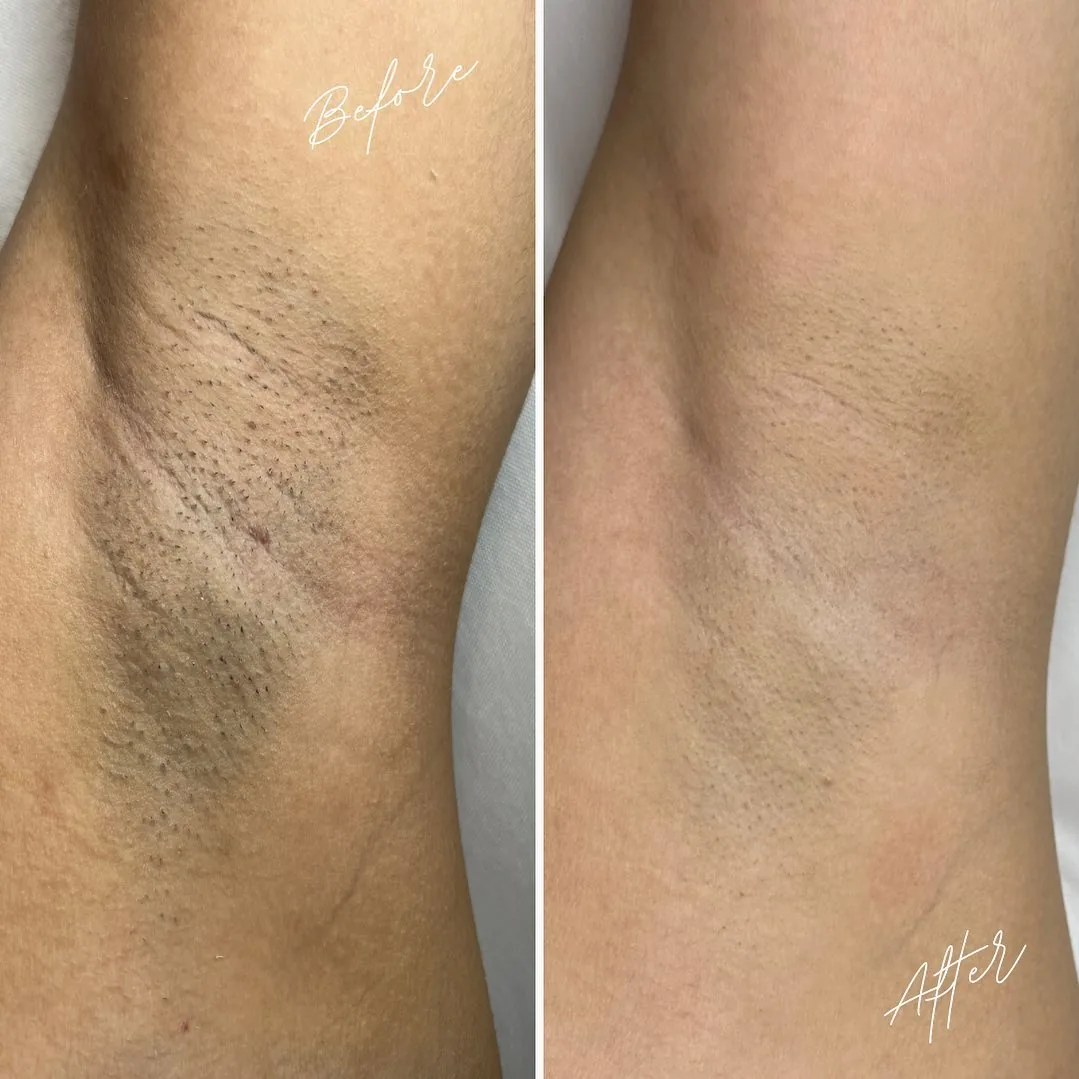 Before and after: underarms — 3 sessions, Cynosure Elite+ laser