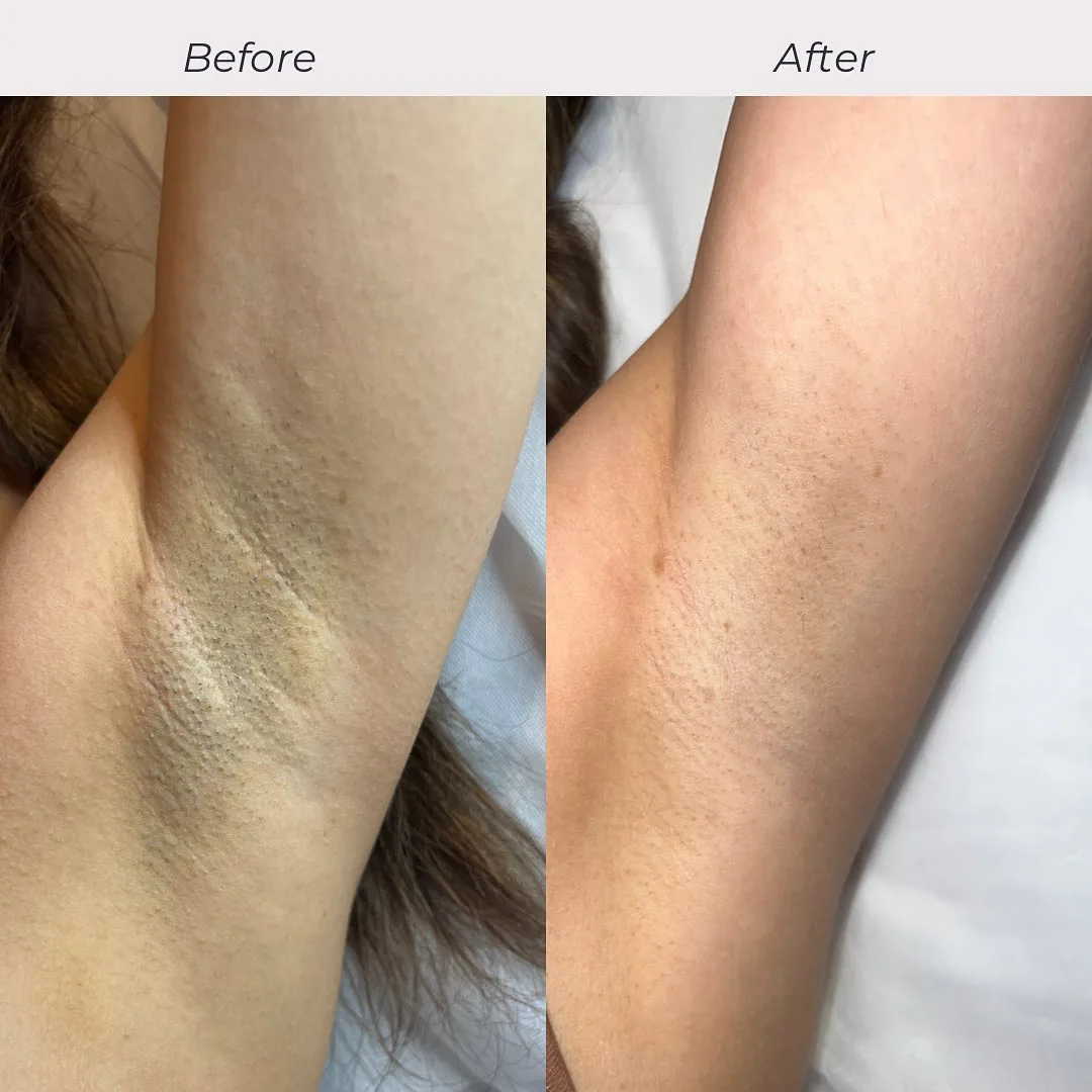 Before and after: underarms — 3 sessions