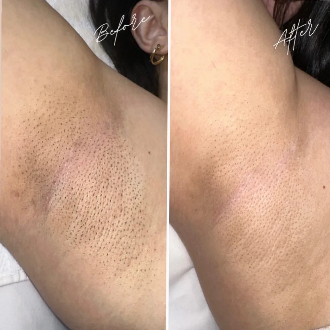 Before and after: underarms — Laser hair removal