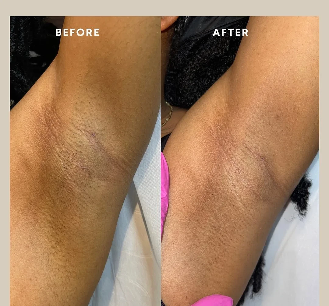Before and after: underarms — 1 session