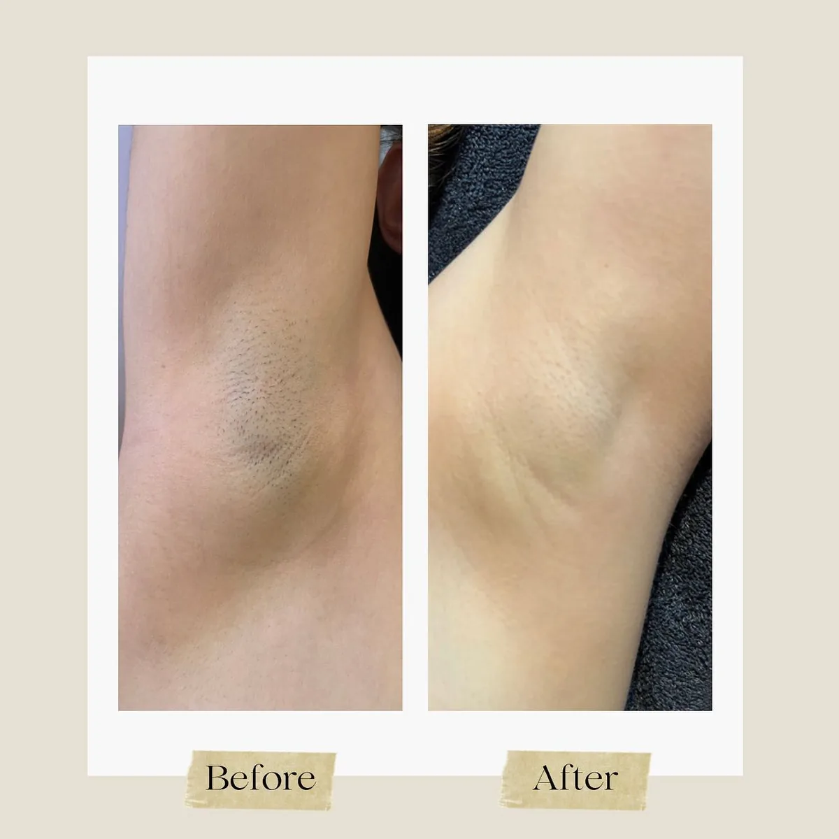 Before and after: underarms — 3 sessions — fewer hairs, remaining hair much finer