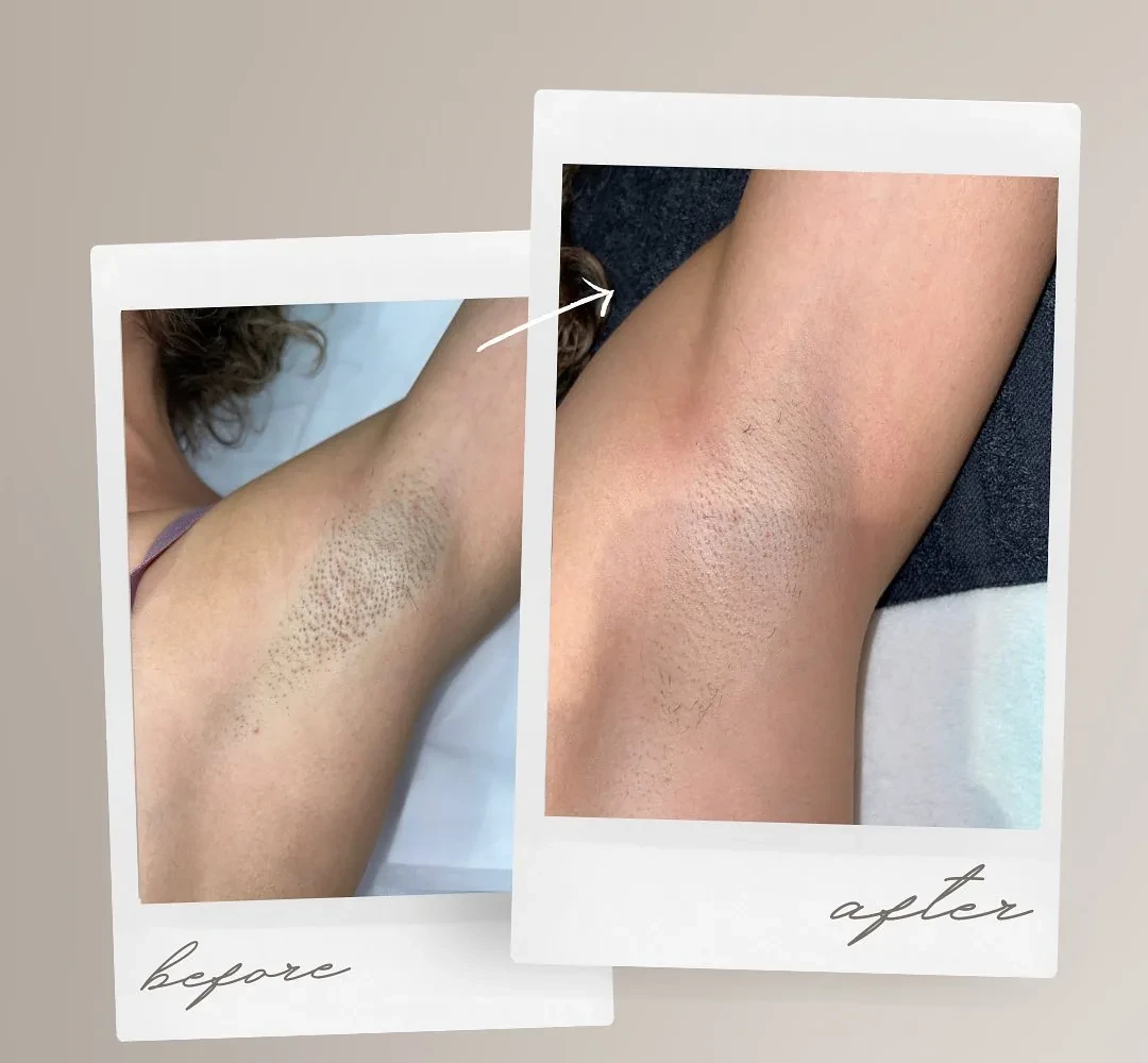 Before and after: underarms — Laser hair removal