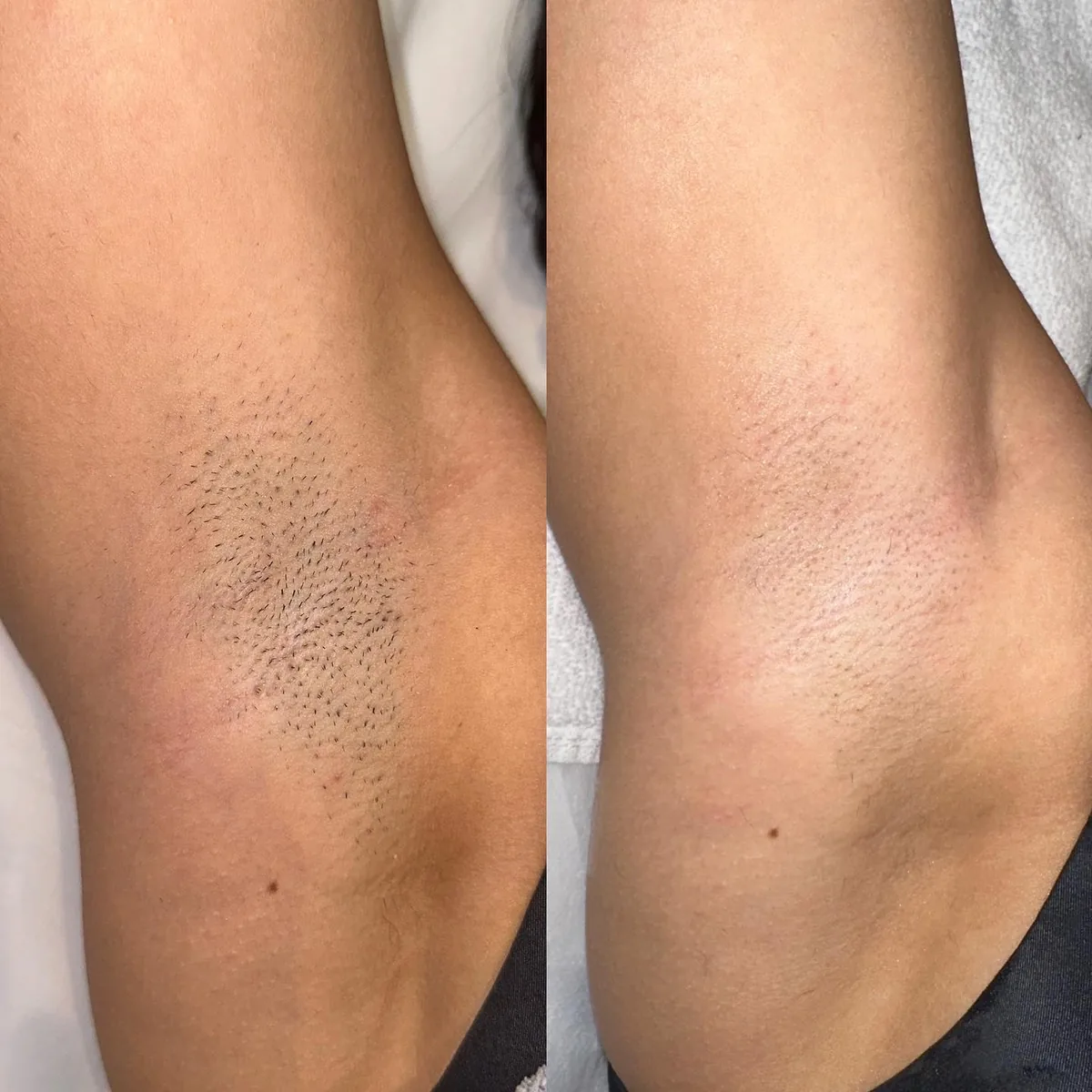 Before and after: underarms — Laser hair removal