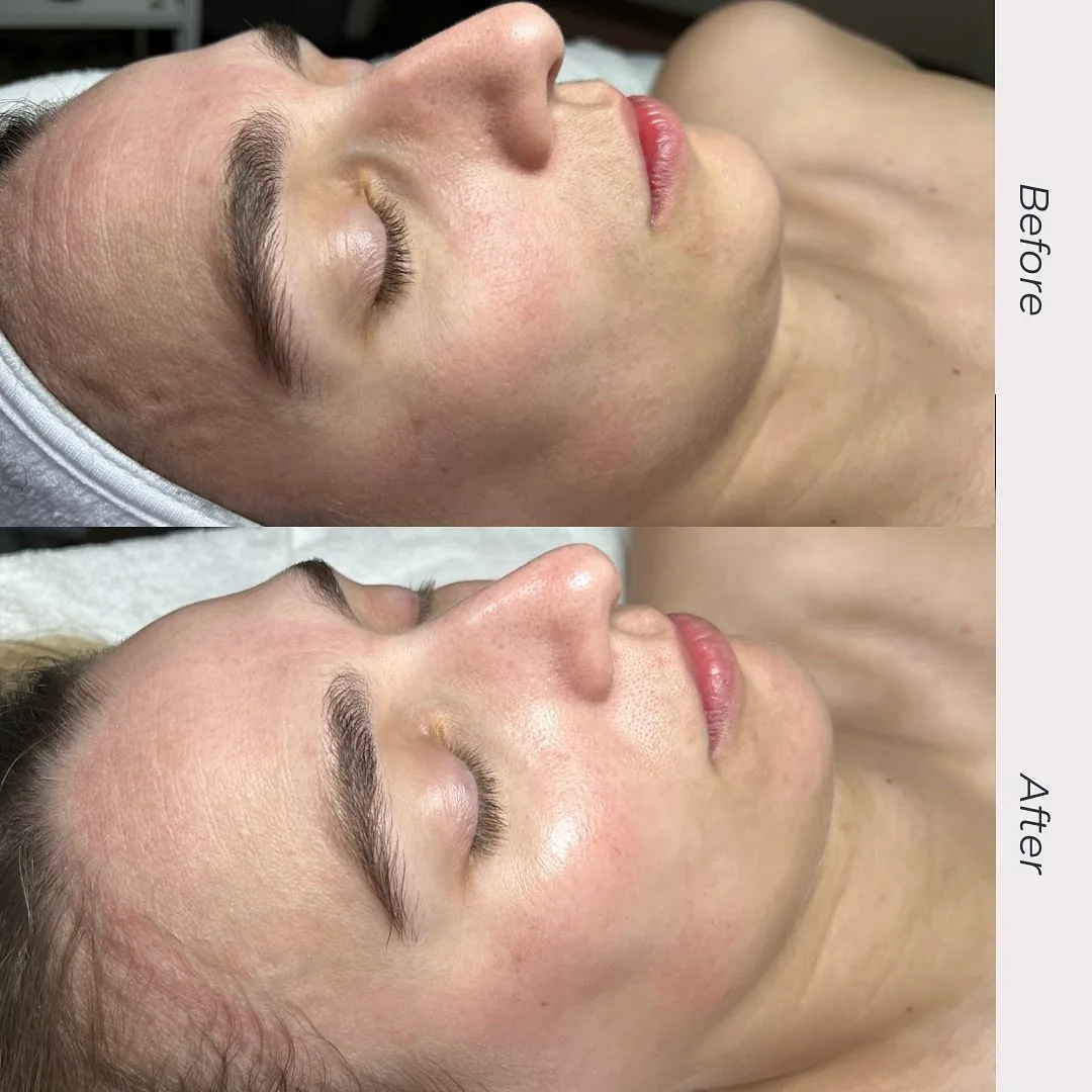 Before and after: face and neck — Personalized treatment plan