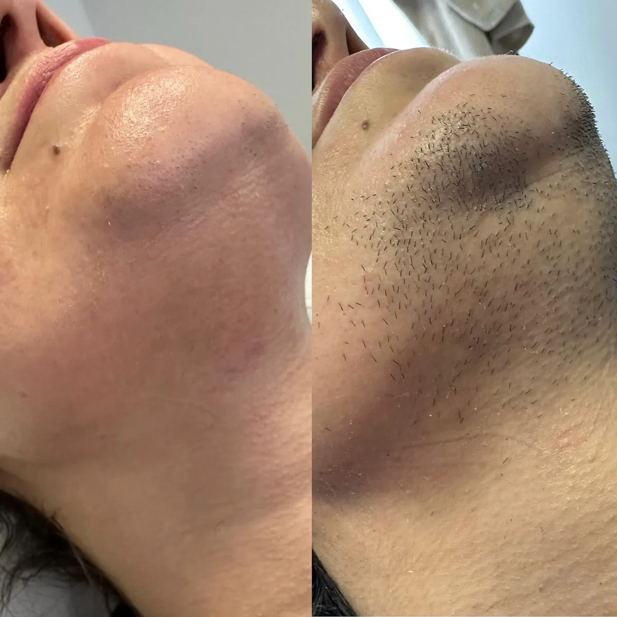 Before and after: chin and neck — Hormone-related hair growth