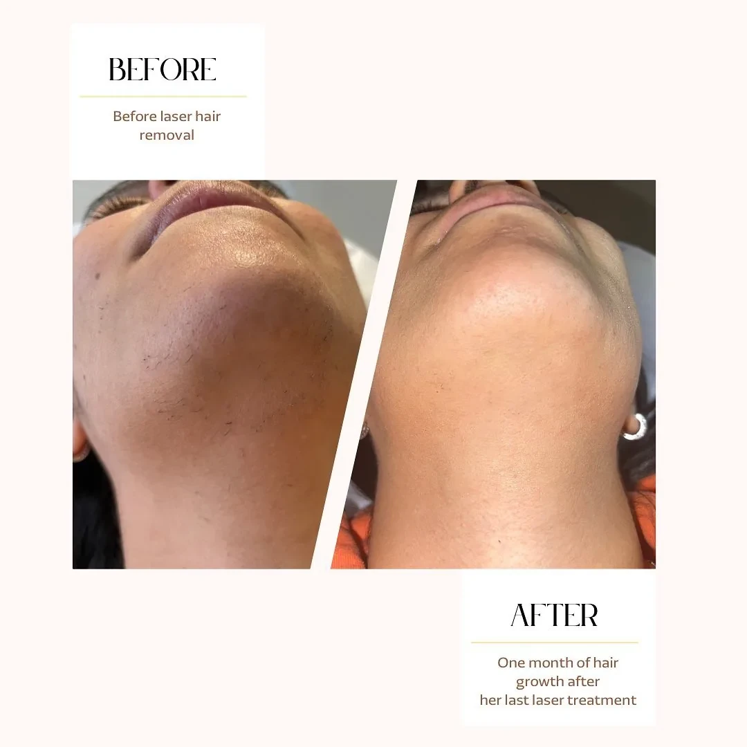 Before and after: chin and neck — One month after the last session