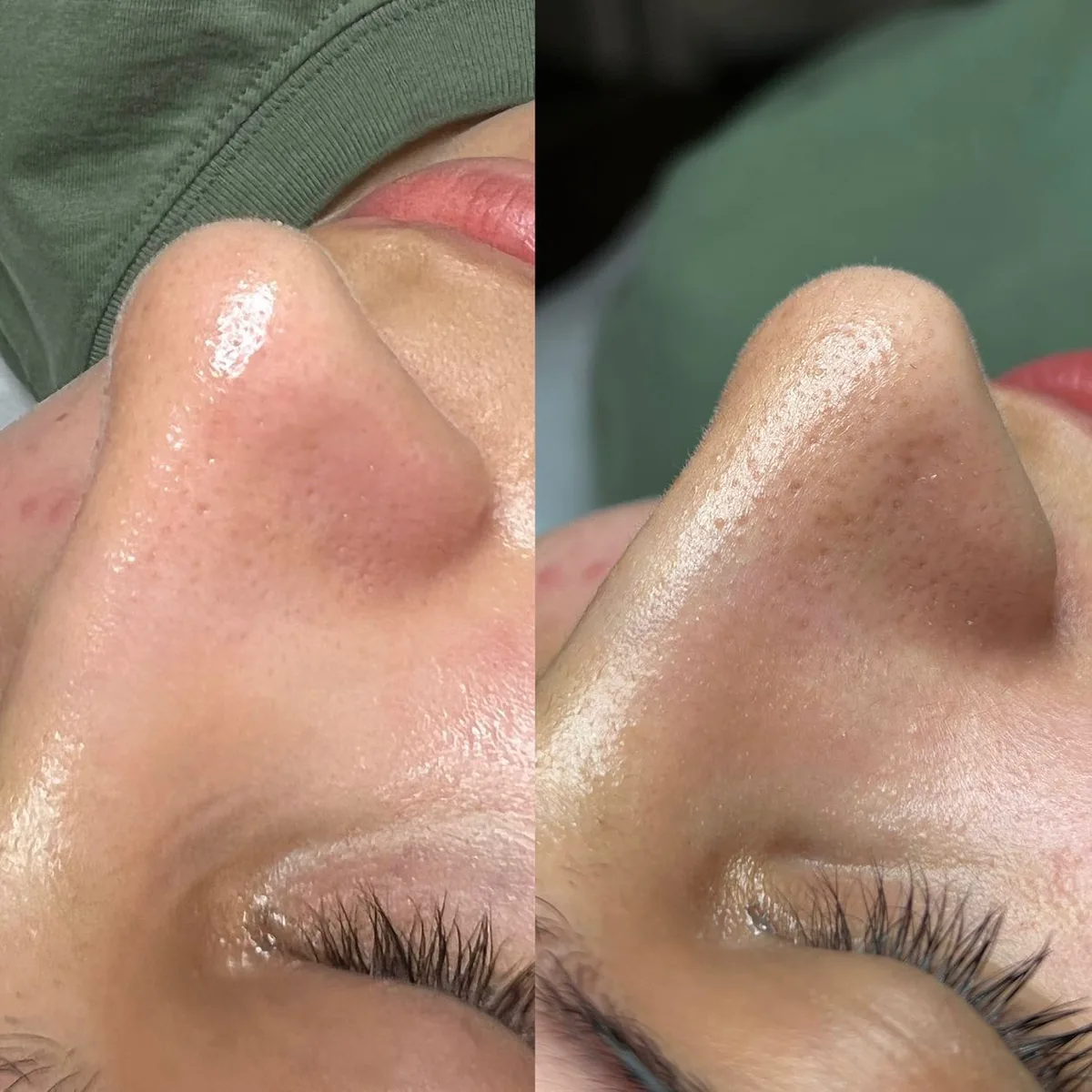 Before and after: nose — Hydrafacial
