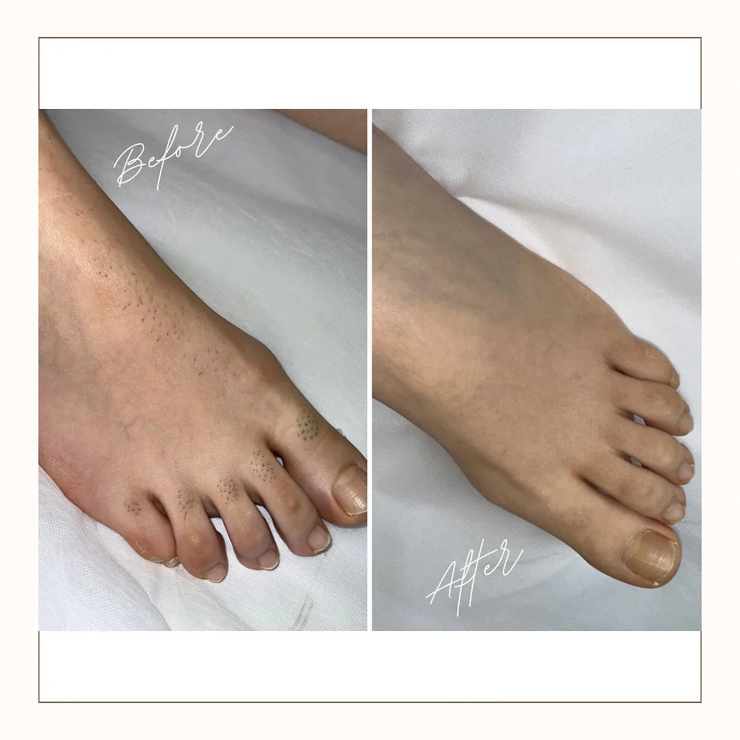 Before and after: toes — 4 sessions
