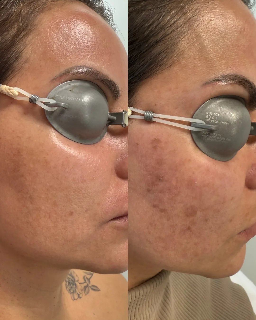 Before and after: face — Pigmentation spots, Elite iQ laser — after a single session