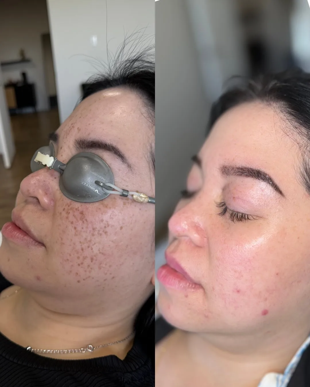 Before and after: face, side view — Pigmentation spots, Cynosure Elite iQ laser