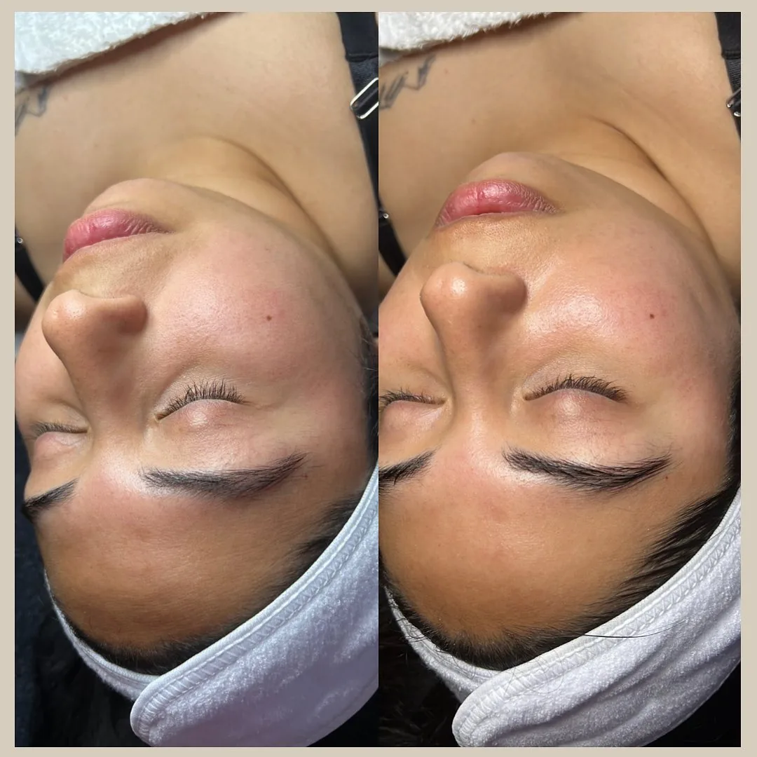 Before and after: face — Hydrodermabrasion
