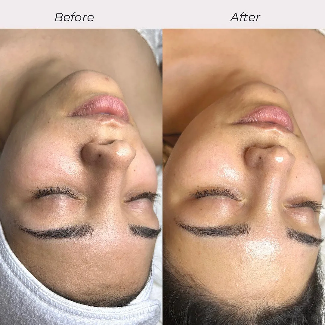 Before and after: face — Customized Hydrafacial