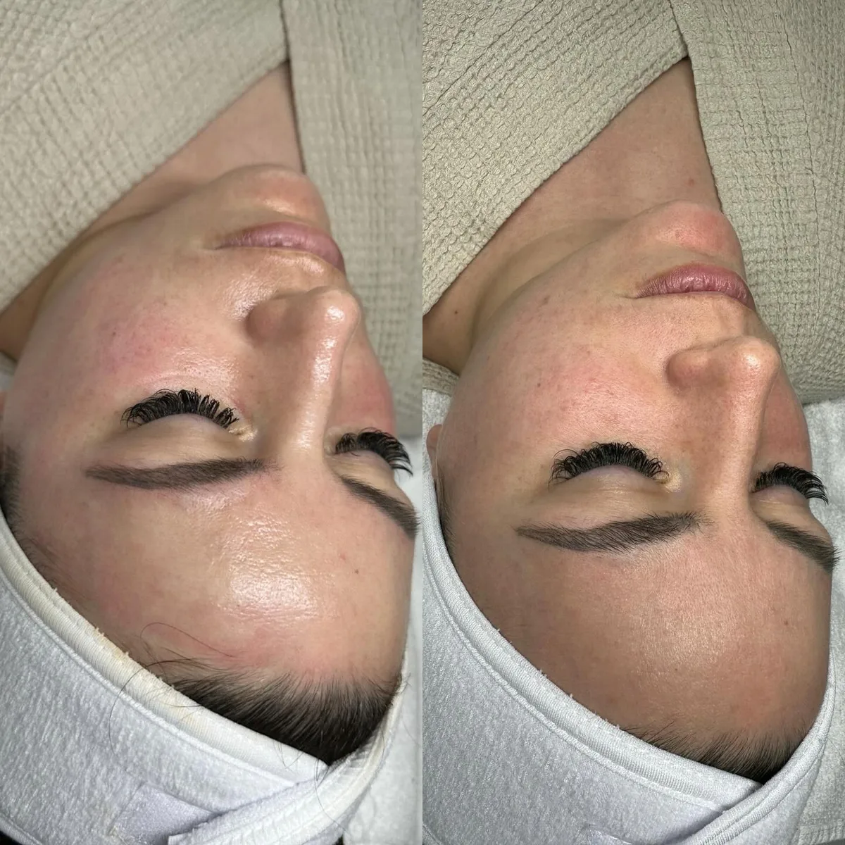 Before and after: face — Hydrafacial