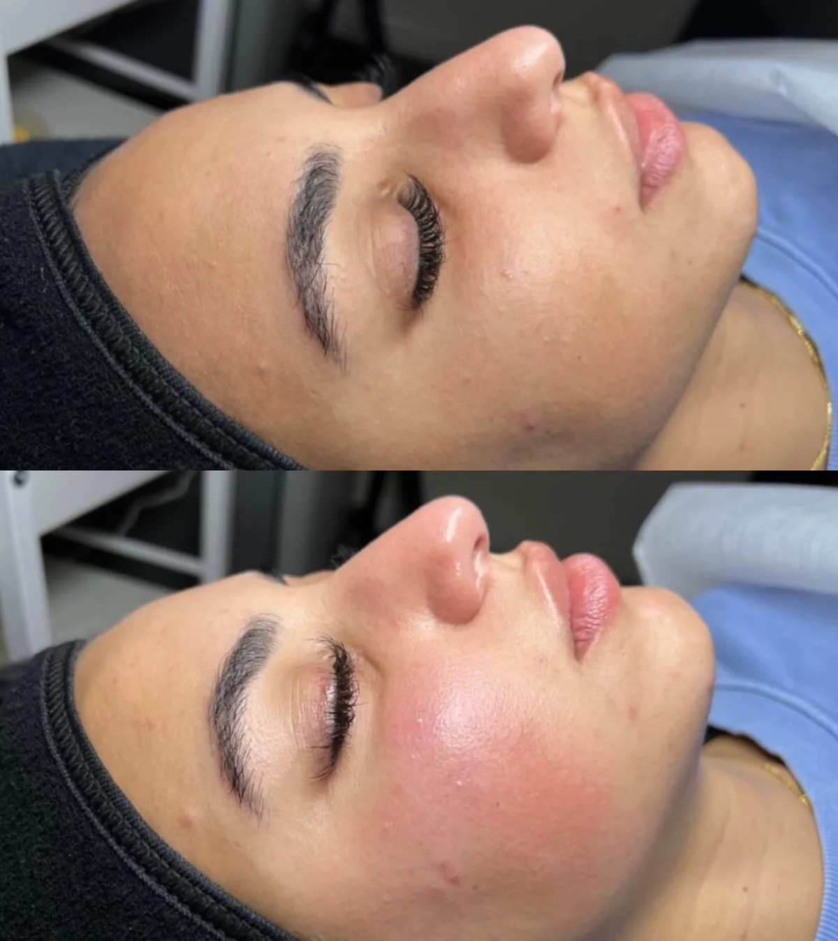 Before and after: face — Dermaplaning + custom Hydrafacial
