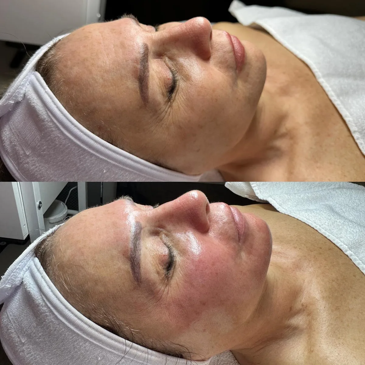 Before and after: face — Platinum Hydrafacial, anti-ageing