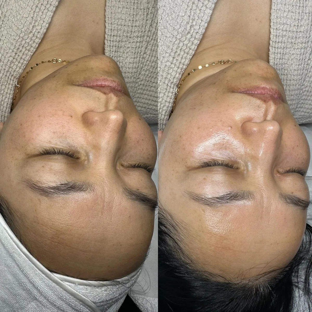 Before and after: face — Dermaplaning + Platinum Hydrafacial