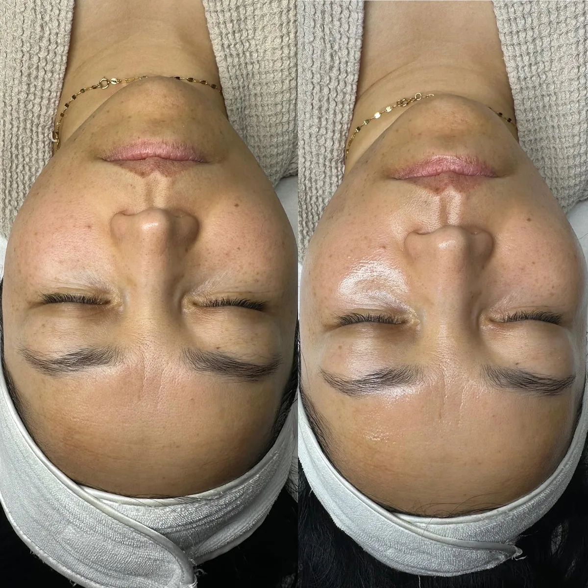Before and after: face — Dermaplaning + Platinum Hydrafacial