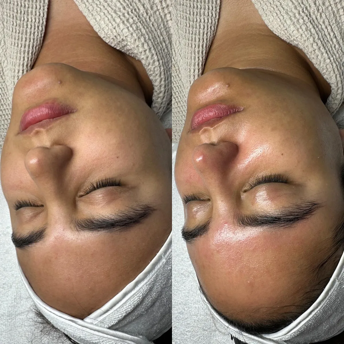 Before and after: face — Hydrafacial