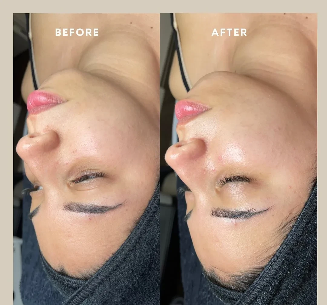Before and after: face — Dermaplaning