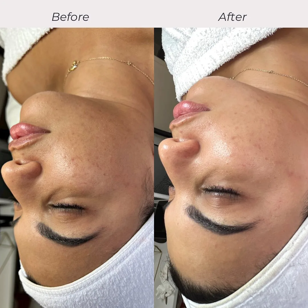 Before and after: face — Hydrafacial with dermaplaning and red LED
