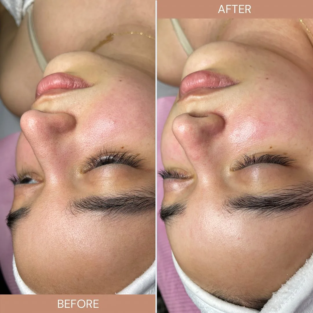 Before and after: face — Signature Glow facial — immediate result