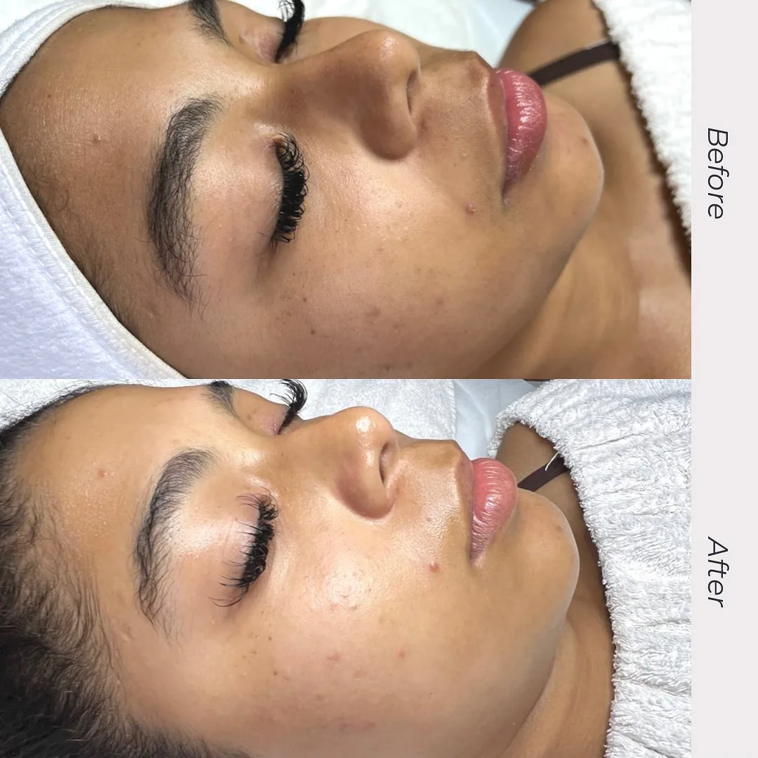 Before and after: face — Customized Hydrafacial